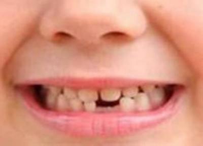 مراقبت از دندان بچه ها